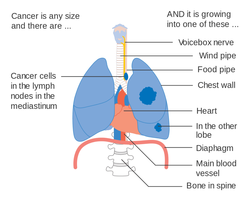 Stage of Lung over