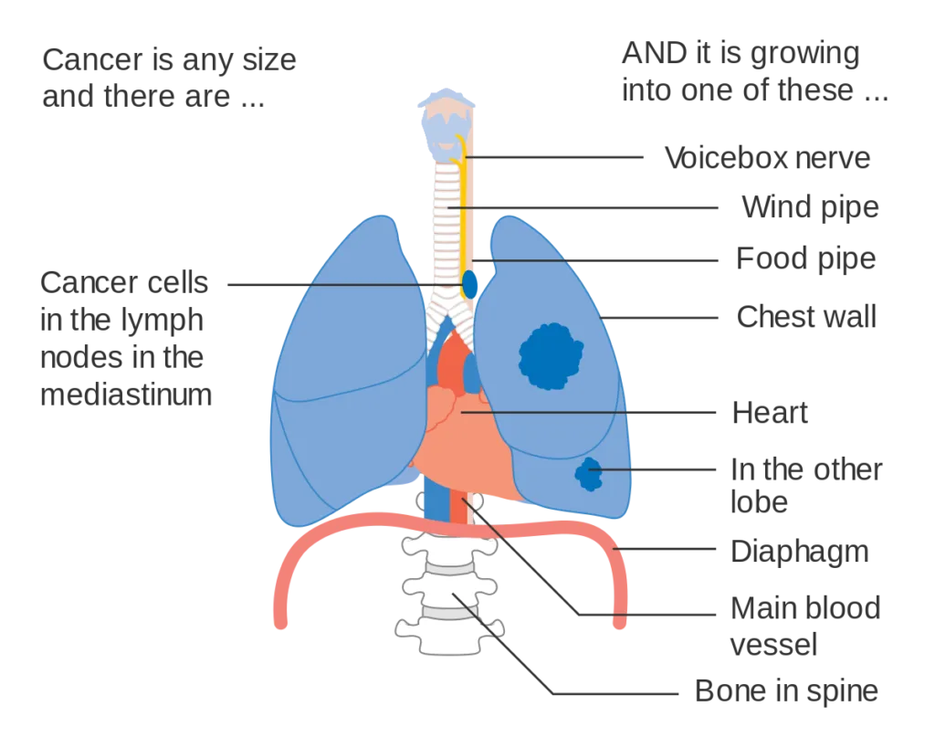 Stage of Lung over